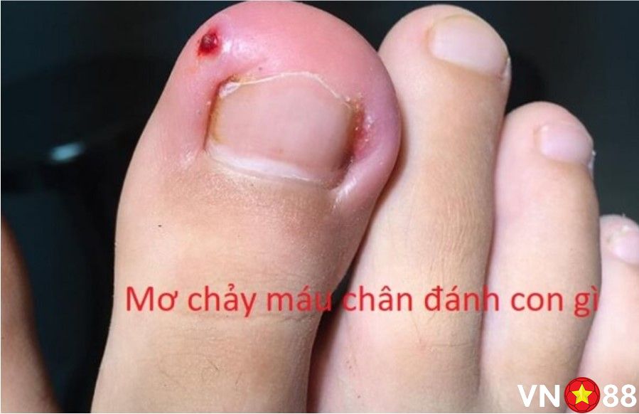 Chiêm bao thấy chảy máu ở ngón chân